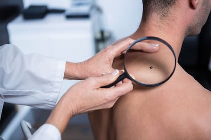 Según la doctora, los lunares benignos tienen que ser simétricos con los bordes bien redondeados y un solo tono de color