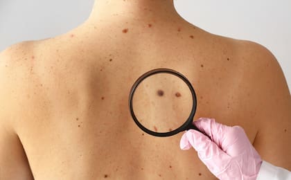 Según las proyecciones, se estima que la aparición de 1703 nuevos casos de cáncer de piel por año