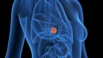 Según un importante informe sobre el cáncer de aparición precoz, el de mama es el que más ha aumentado en número de casos.