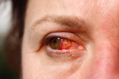Si el adhesivo de las extensiones de pestañas entran en contacto con el ojo, pueden producir una dolorosa conjuntivitis.