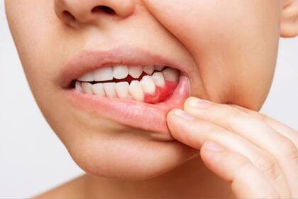 Si la placa bacteriana no se elimina adecuadamente con una buena higiene bucal, puede calcificarse y convertirse en sarro