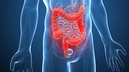 Si se diagnostica a tiempo, el cáncer de colon puede ser curable