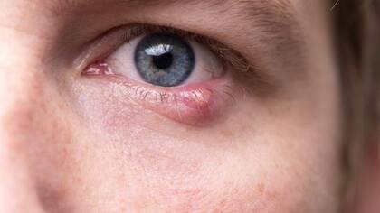 Si tenés conjuntivitis y no sabés qué ha podido causarlo, preguntate si has mantenido relaciones sexuales de riesgo.