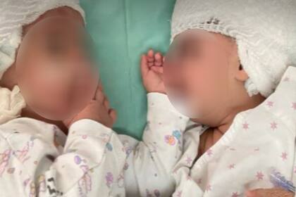 Siamesas que estaban unidas por la cabeza fueron operadas y se vieron por primera vez tras la operación