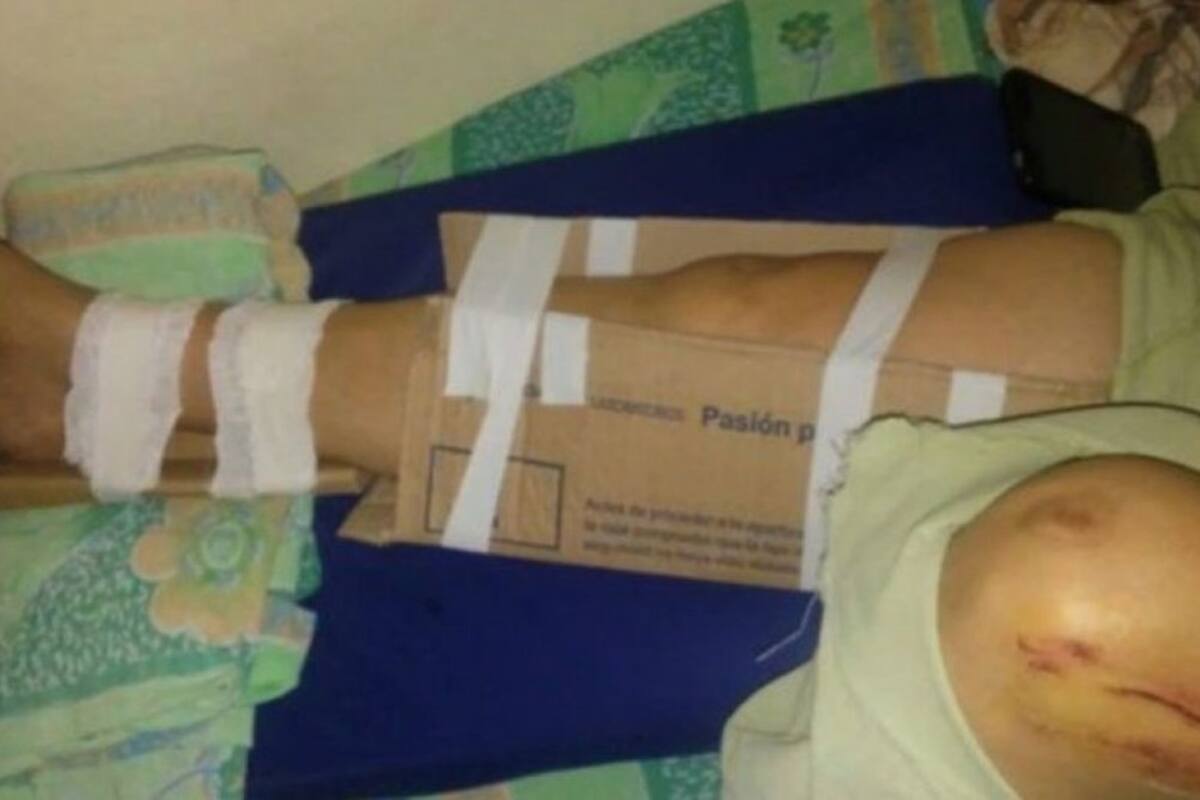 Sin yeso en un hospital chaqueño, le inmovilizaron la pierna con cartón y cinta