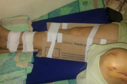 Sin yeso en un hospital chaqueño, le inmovilizaron la pierna con cartón y cinta