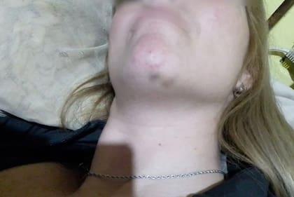 Soledad, la mujer que denunció a los rugbiers franceses Hugo Auradou y Oscar Jegou, dio a conocer algunas fotos de las marcas en su cuerpo tras las agresiones