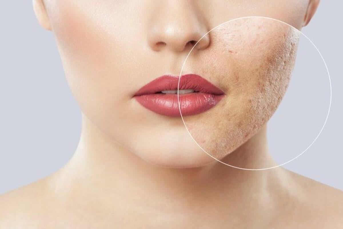 Son varios los especialistas que hablan del incremento de casos de acné por el uso continuado de la mascarilla
