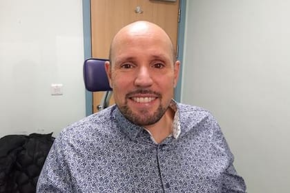 Steve Verze muestra su prótesis ocular hecha con una impresora 3D