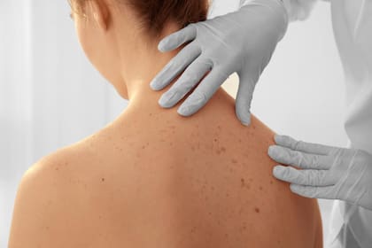 Su aparición más frecuente se debe a la exposición solar, la predisposición genética y el uso de ciertos productos cosméticos o medicamentos