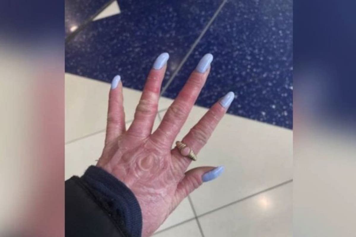 Su extraña condición de la piel y los comentarios que recibió afectaron a la salud mental de Rhiannon.