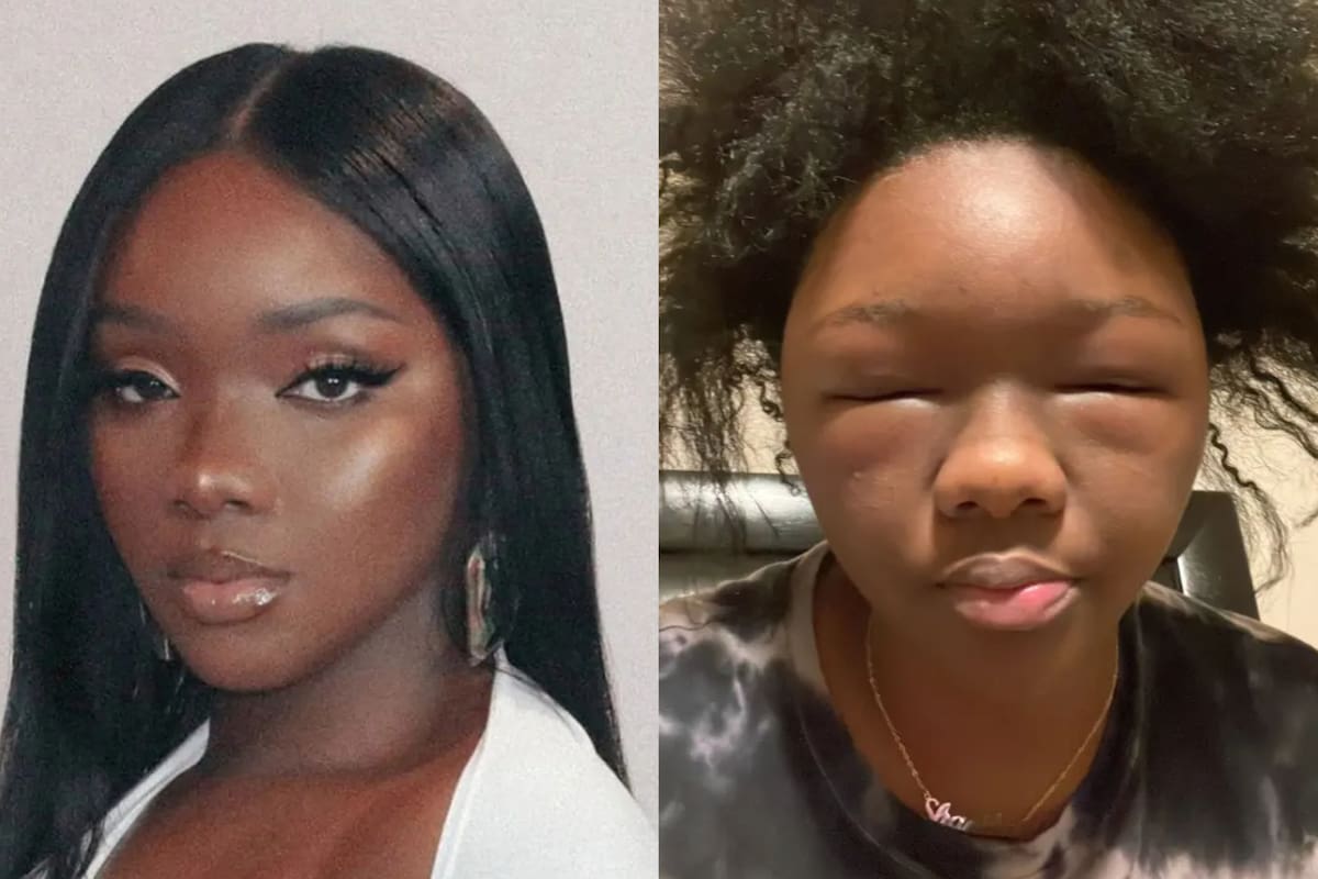 Sufrió una reacción alérgica a la tintura: su cara se deformó y quedó ciega por unos días