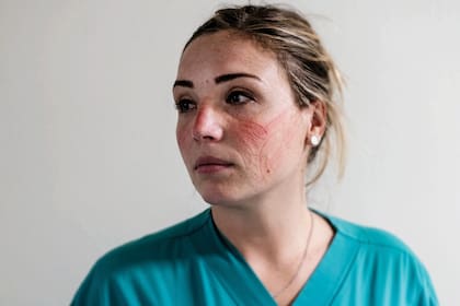 Las marcas en la cara que le dejan los elementos de protección al personal de la salud