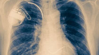 ¿Te parece insensato meterse aparatos al cuerpo? Piensa en los marcapasos. La gran diferencia -y riesgo- es que la gran mayoría de estos biohackers no tienen conocimientos médicos