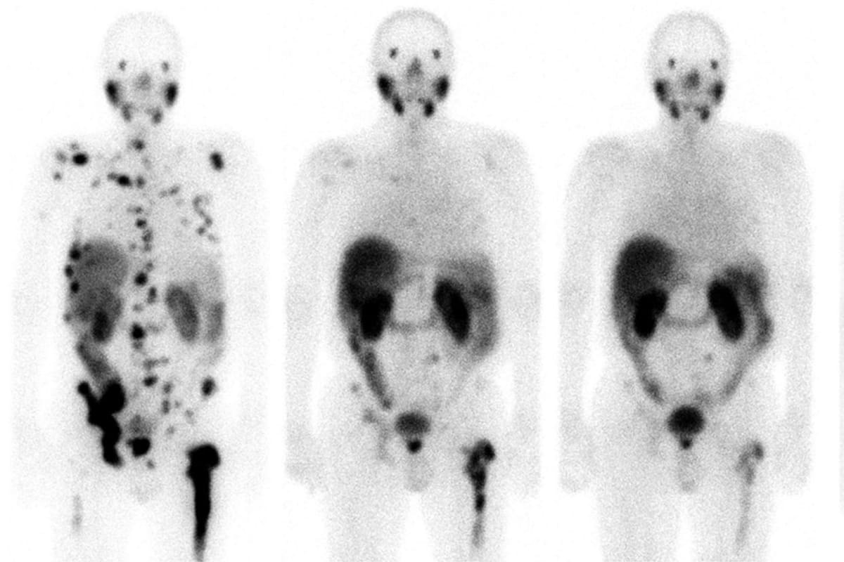Teragnosis una nueva esperanza contra el cáncer