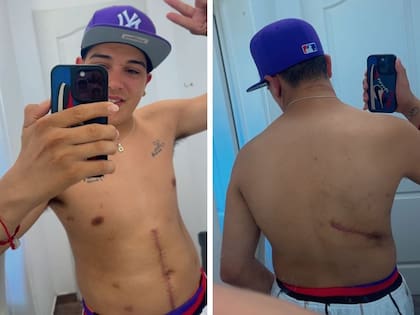 Thiago Medina mostró cómo quedó su cuerpo tras el accidente en moto que casi le cuesta la vida