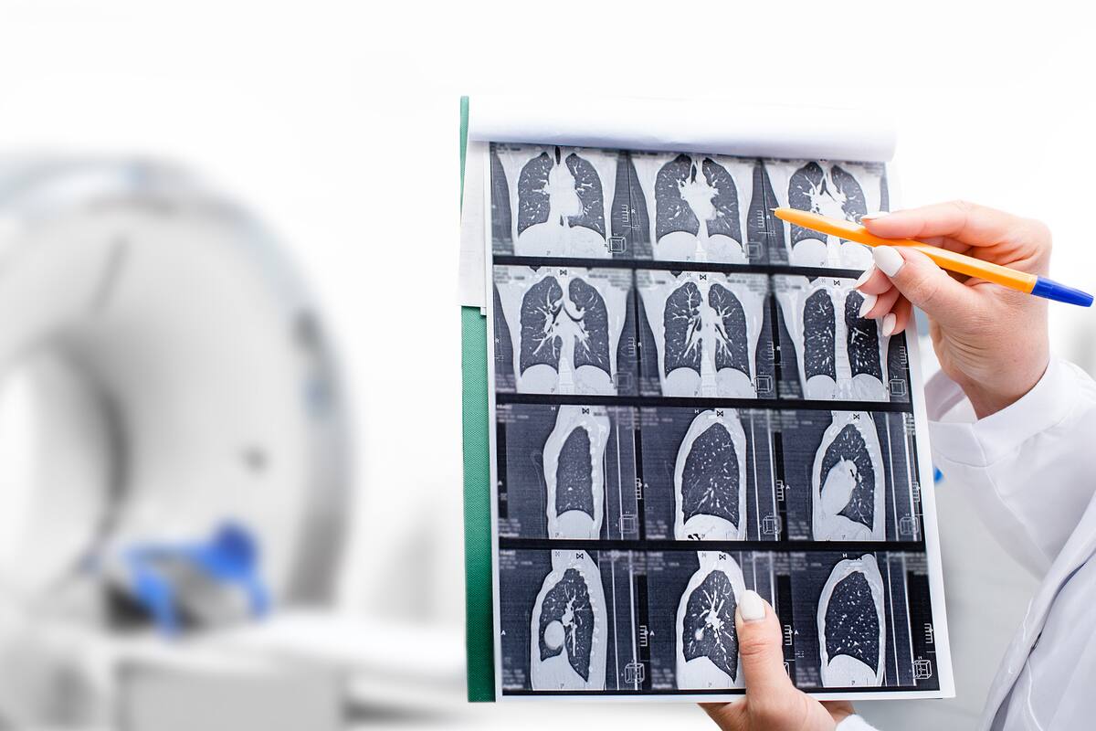 Tomografía; Cáncer de Pulmón; sociedad