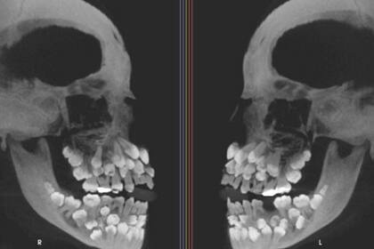 Tomografía computada de la niña de 11 años en la que se ve que cuenta con 81 dientes