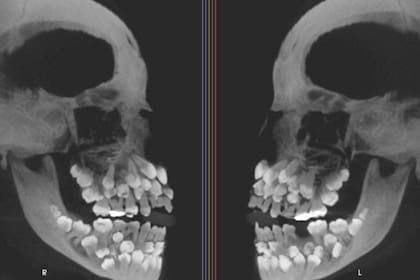 Tomografía computada de la niña de 11 años en la que se ve que cuenta con 81 dientes