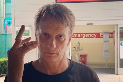Tony Hawk y sus dedos fracturados después de una caída. Fuente: Instagram