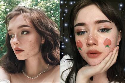 Tras la defensa de los cuerpos reales, muchos se afirman a través de una de las afecciones de piel más comunes; las celebrities también se suman