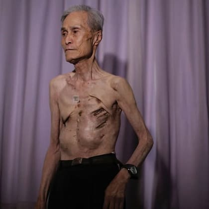 Tsutomu Yamaguchi muestra las heridas que le dejaron los ataques nucleares