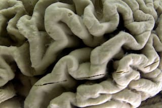 Un análisis de sangre ayuda a detectar un alto riesgo de Alzheimer en pacientes sanos