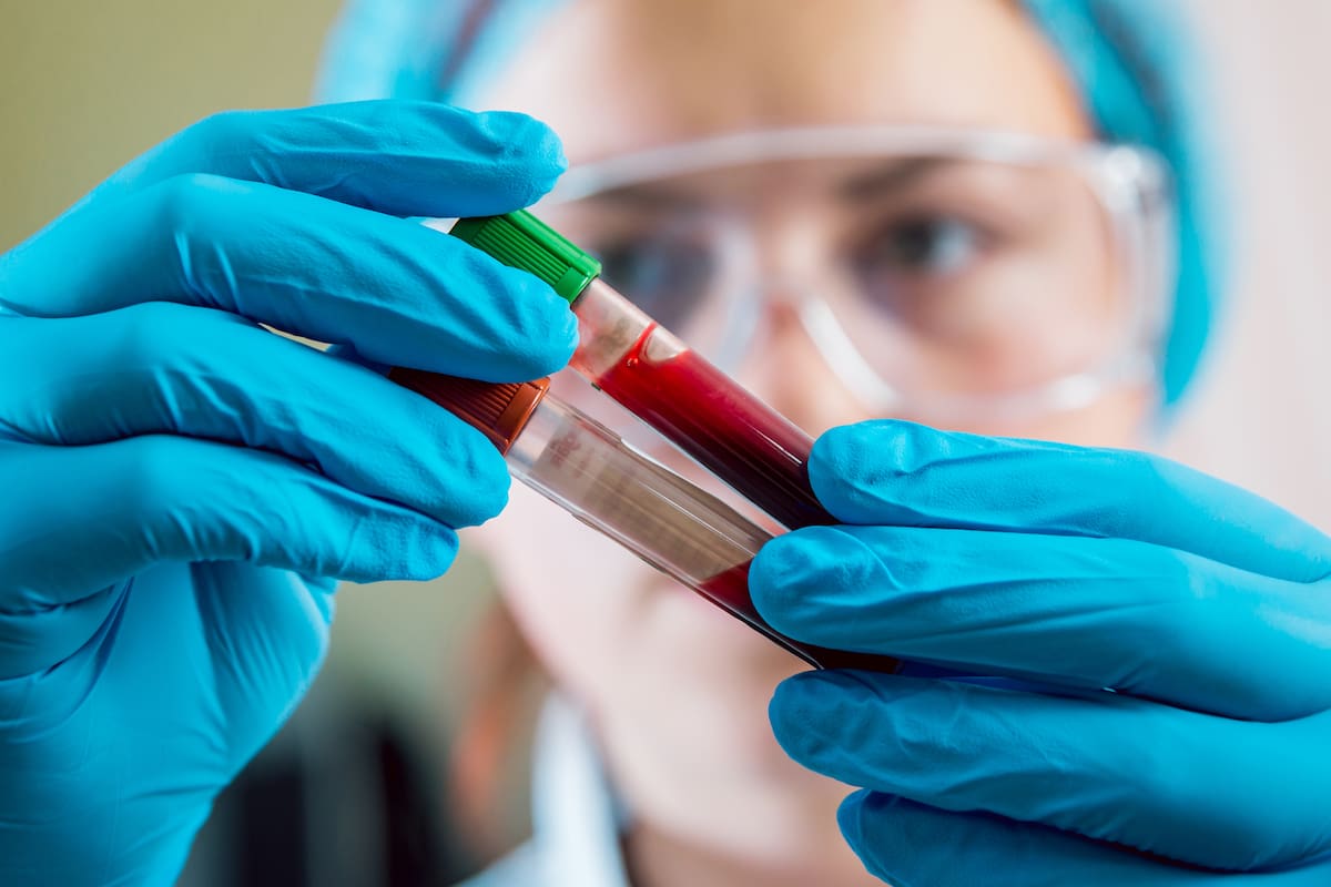 Un análisis de sangre verifica el antígeno prostático específico (PSA), un posible signo del cáncer de próstata