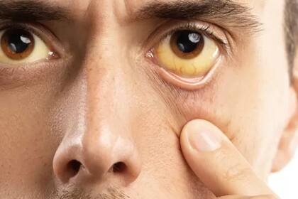 Un cambio en "el blanco de los ojos" hacia una coloración amarilla podría ser signo de una irritación o de infección