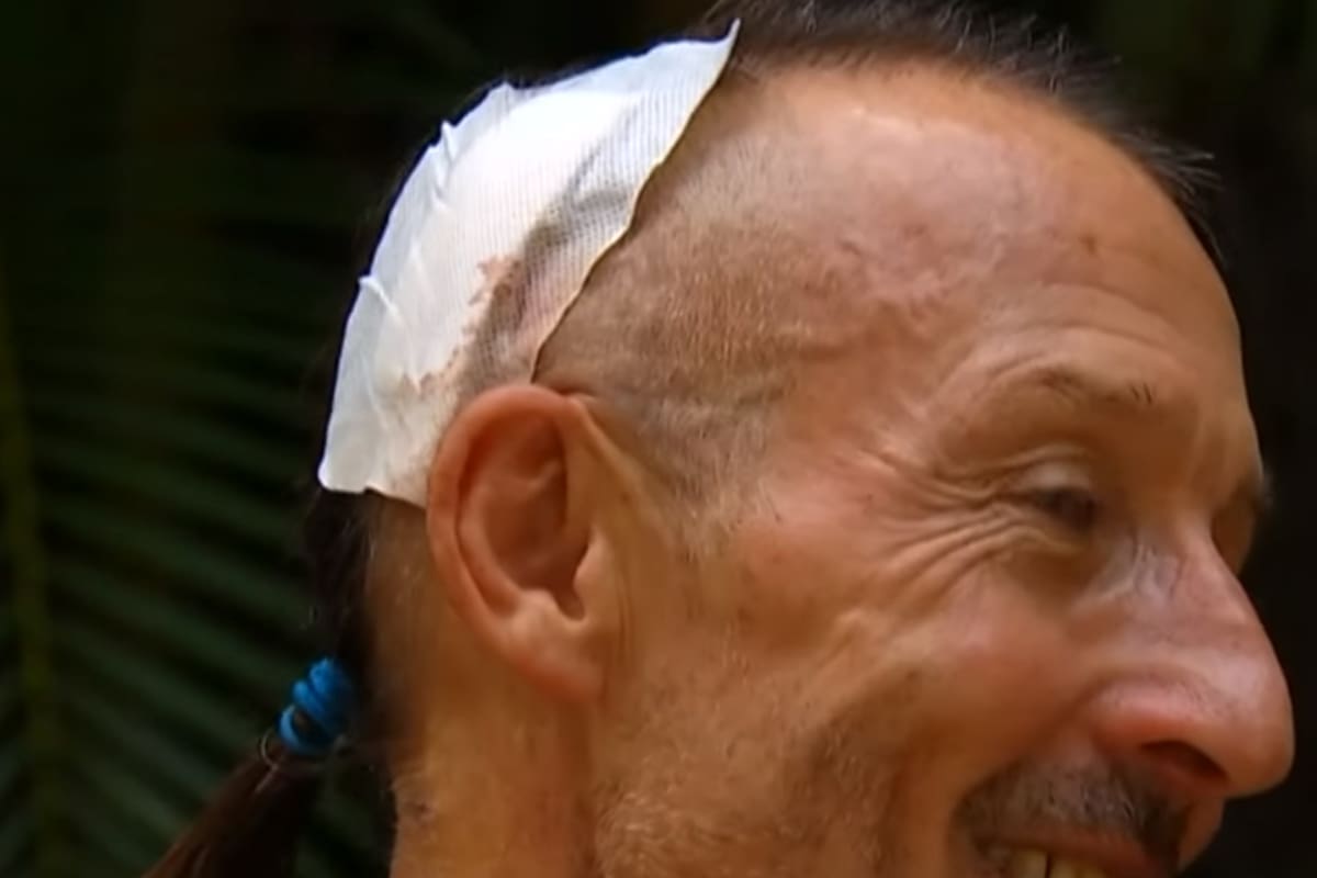 Un cocodrilo le mordió la cabeza y vivió para contarlo y mostrar su heridas con orgullo (7News)