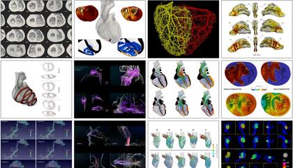 Un desarrollo del Barcelona Supercomputing Centery de ELEM Biotech permite crear un gemelo digital de un corazón y simular su funcionamiento a lo largo del tiempo, y su reacción a diversos fármacos