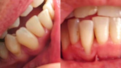 Un diente flojo y la encía reducida. Esta es la boca de Jamie nueve meses después de comenzar a utilizar los alineadores de Smile Direct Club.