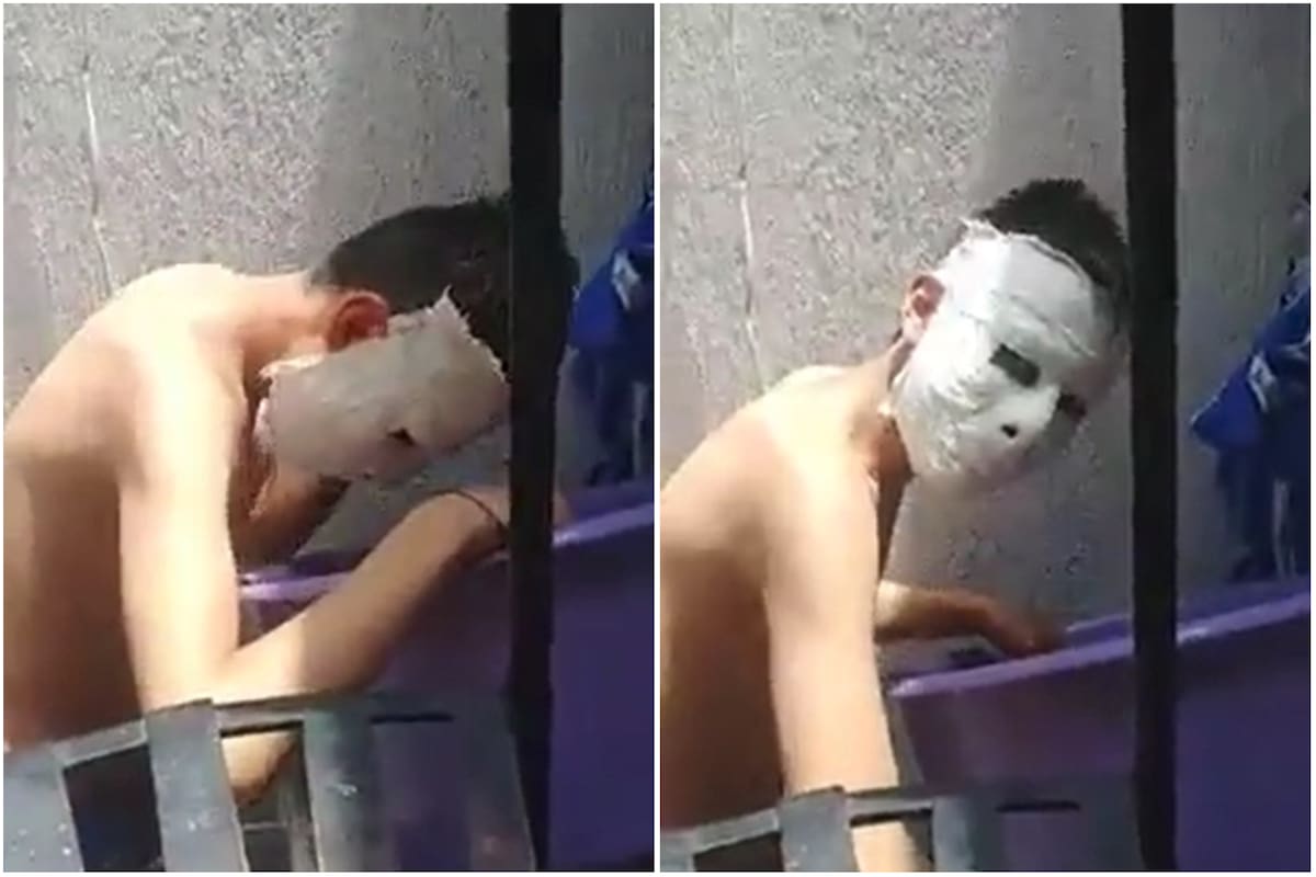 Un estudiante fabricó una máscara de yeso sobre su rostro y no pudo quitársela