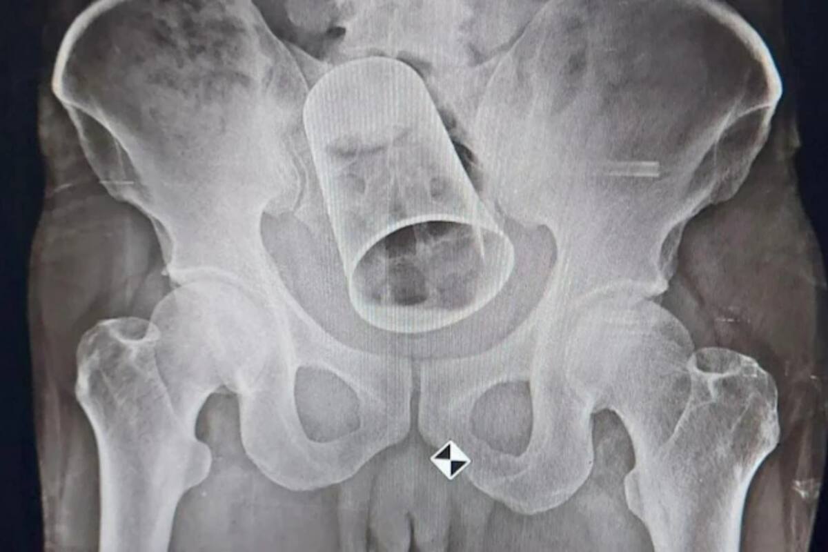 Un hombre de India fue víctima de una mala broma de sus amigos y terminó en un hospital después de descubrir un vaso de metal en el recto