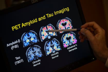Un médico señala imágenes de un escáner cerebral dentro de un estudio sobre el Alzheimer en el hospital de la Universidad de Georgetown, el martes 19 de mayo de 2015 en Washington