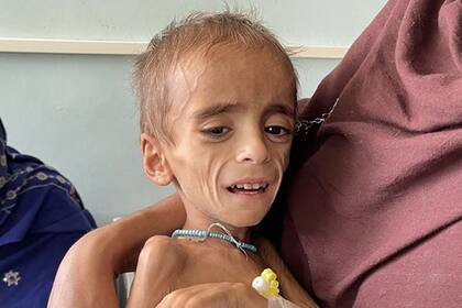 Un niño con desnutrición en Kandahar, en Octubre