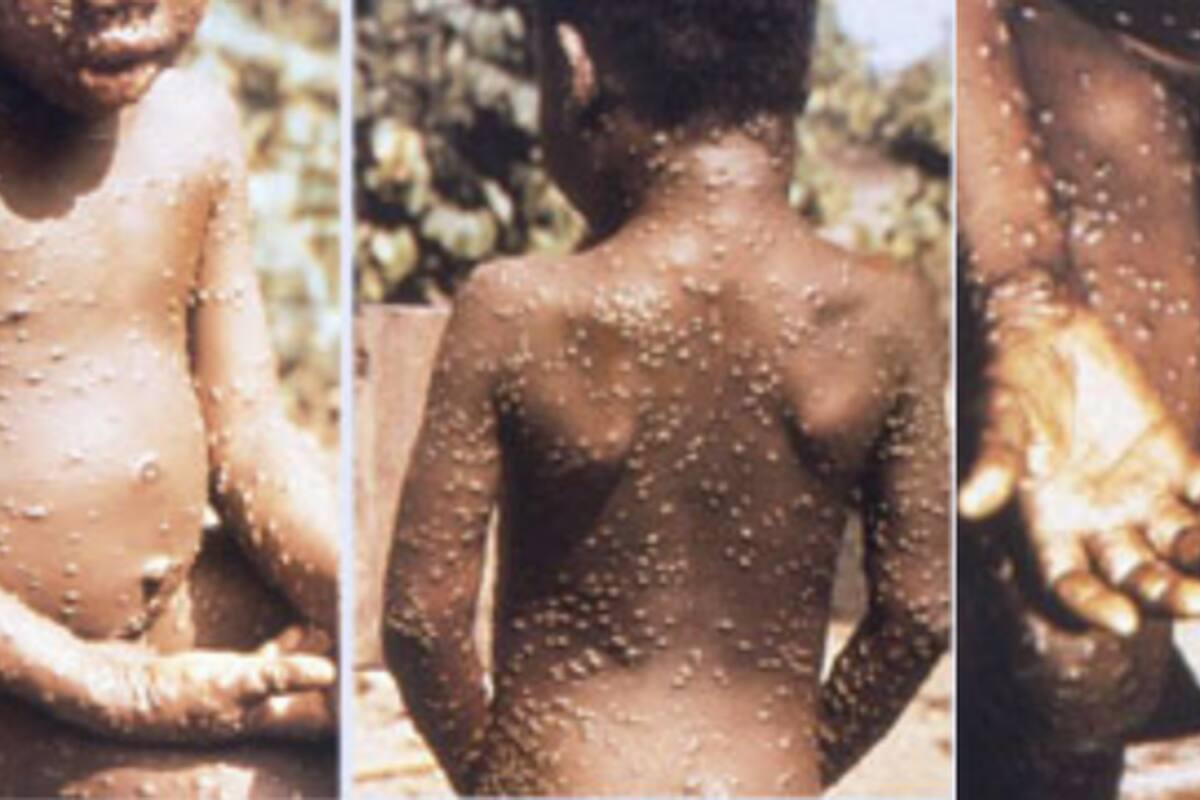 Un paciente con erupciones causadas por la viruela del simio, que es endémica en África central