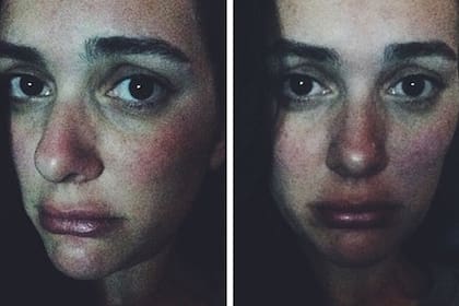 Una alergia dejó a Bergüzar Korel con esta cara de pucherito