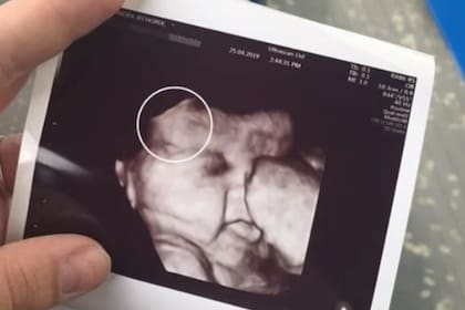 Una de las ecografías en las que la melena comenzaba a notarse
