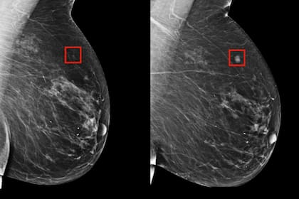 Una de las imágenes analizadas por el sistema entrenado con métodos de aprendizaje automático pudo detectar patrones sutiles al ojo humano para la detección temprana del cáncer de mama