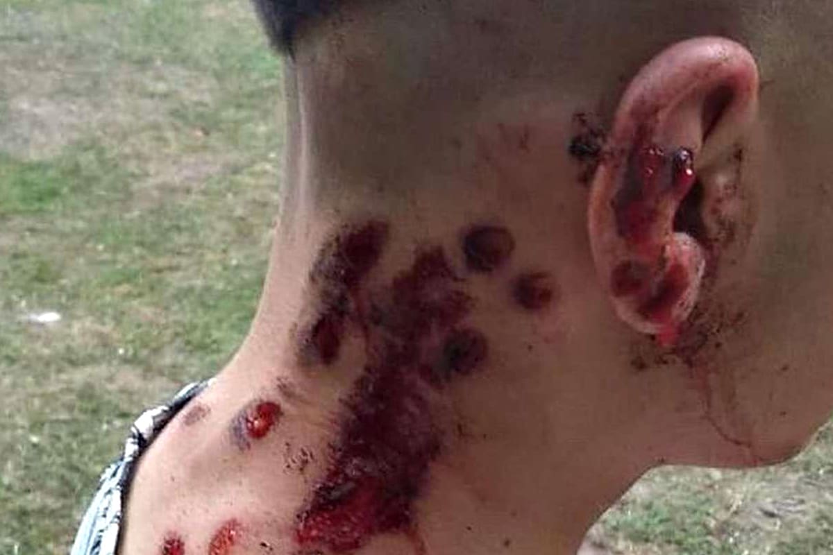 Una de las personas que recibió disparos de balas de goma