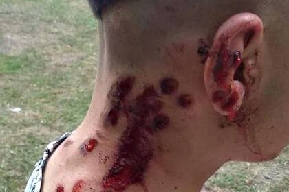 Una de las personas que recibió disparos de balas de goma