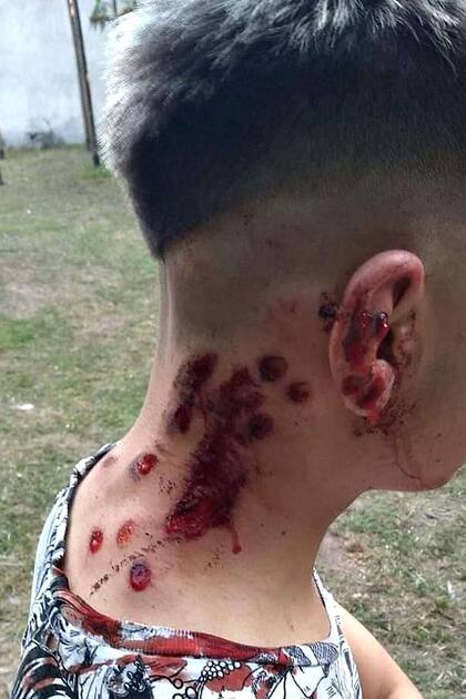 Una de las personas que recibió disparos de balas de goma