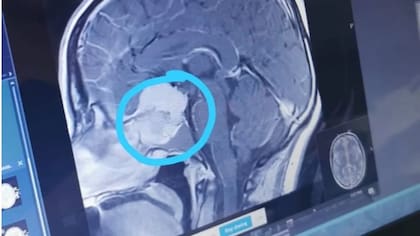 Una exploración del hospital reveló un gran meningioma en el cerebro de la Sra. Dunn