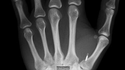 Una imagen de rayos X de la mano izquierda del doctor Mark Gasson muestra cuán pequeños pueden ser los implantes de microchips