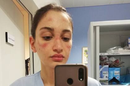 Una joven que trabaja en el sistema de salud italiano mostró su rostro después de una jornada de trabajo y contó cómo se vive el día a día combatiendo al coronavirus