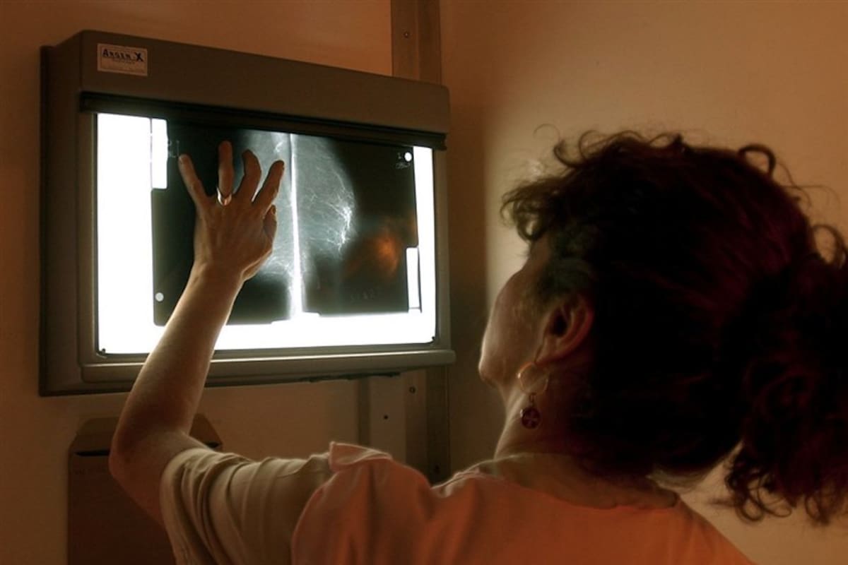Una mamografía cada dos años evita casi una de cada tres muertes por cáncer de mama