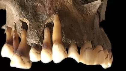 Una muestra de ADN con herpes labial usada en el estudio provenía de un hombre holandés del siglo XVII