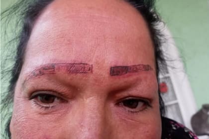 Una mujer denunció el trabajo mal hecho de dos tatuadores: terminó con el rostro quemado