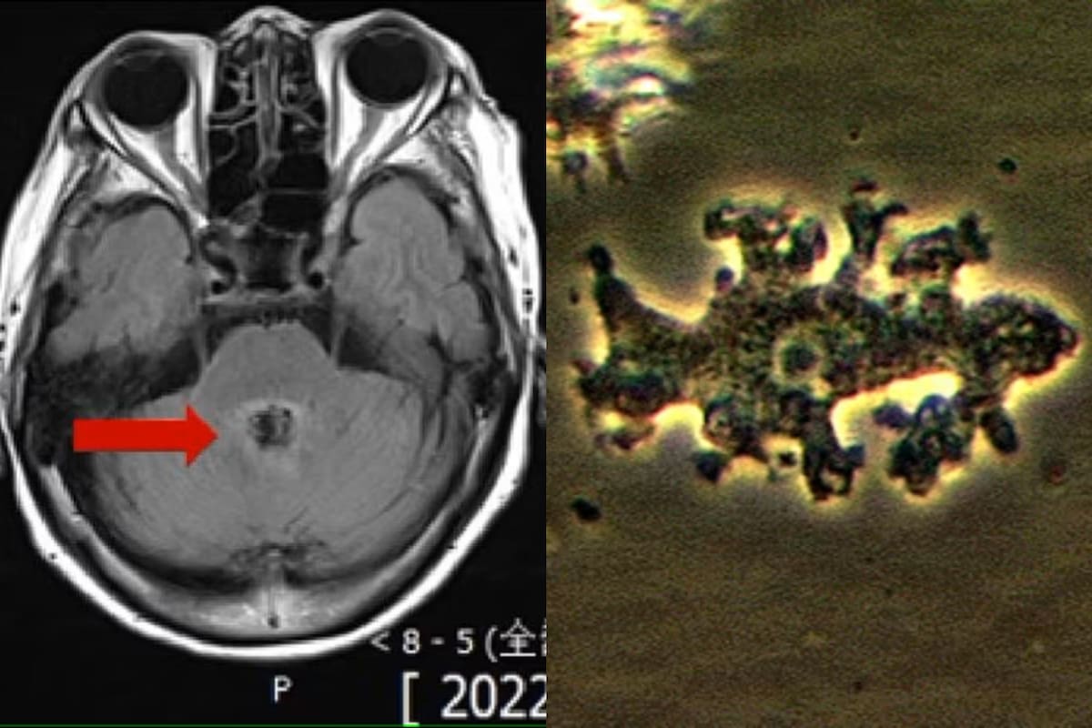Una mujer fue infectada por una ameba en su cerebro y murió